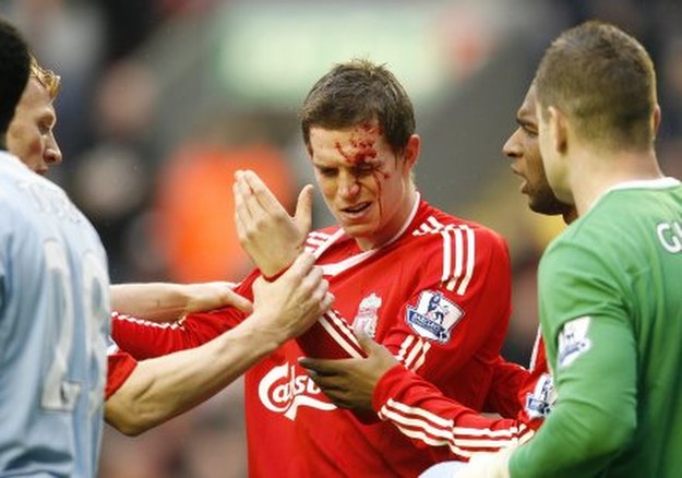 Daniel Agger z rozbitą głową podczas meczu z Manchesterem City. /AFP