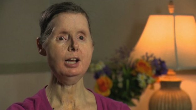 60-letnia Charla Nash z Connecticut w 2009 r. została zaatakowana przez rozwścieczonego szympansa. Zwierzę odgryzło jej dłonie i zmasakrowało twarz. Kobieta straciła gałki oczne. Zamiast ust miała jedynie niewielki otwór, przez który przyjmowała płyny… W 2011 r. lekarze przeszczepili jej twarz.


Dziś Charla domaga się od stanu Connecticut odszkodowania w wysokości 150 milionów dolarów. Zgromadzenie Ogólne stanu Connecticut zadecyduje, czy będzie mogła skierować pozew przeciwko władzom stanowym do sądu (w czerwcu 2013 pierwszy wniosek kobiety w tej sprawie został odrzucony).


Prawnicy kobiety wskazują, że w czasie, kiedy Charla została zaatakowana, w Connecticut obowiązywał zakaz posiadania naczelnych o wadze przekraczającej 50 funtów (ok. 23 kg) bez specjalnego zezwolenia. Co więcej, na kilka miesięcy przed tragedią szympans był badany przez biologa, który w raporcie ostrzegł władze stanowe, iż zwierzę jest agresywne i może zaatakować człowieka, jeśli poczuje się zagrożone. Charla uważa, że obowiązkiem władz stanowych było wcześniejsze schwytanie niebezpiecznego szympansa.