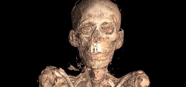 Niezwykła wystawa w Muzeum Brytyjskim pozwala zwiedzającym dosłownie zajrzeć do wnętrza staroegipskich mumii. Naukowcy wykorzystali najnowsze zdobycze techniki –tomografię komputerową i oprogramowanie do tworzenia zaawansowanych wizualizacji 3D - by zajrzeć pod bandaże spowijające ciała, które wiele tysięcy lat temu poddano balsamowaniu...


Dzięki skanowaniu mumii poznajemy nie tylko szczegóły ich anatomii i wyglądu. Możemy też dowiedzieć się, na jakie choroby cierpieli starożytni Egipcjanie i określić, w jakim wieku pożegnali się z doczesnym światem. I tak, naukowcy ustalili, że kobieta o imieniu Tamut - zmarła ok. 900 lat przed Chrystusem - w chwili zgonu miała około 30 lat. Przyczyną śmierci była prawdopodobnie zaawansowana miażdżyca. Inna eksponowana na wystawie mumia po dokładnym zbadaniu tomografem ujawniła dość makabryczny sekret: podczas balsamowania, w trakcie usuwania tkanki mózgowej, doszło do złamania małego narzędzia służącego do tego celu. Jego odłamek już na zawsze utkwił w czaszce zmarłego mężczyzny.