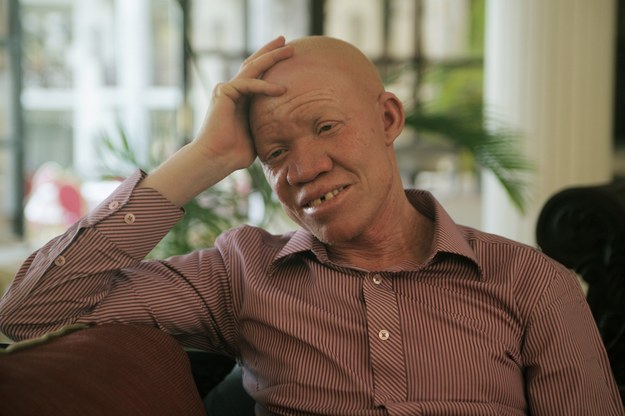 W Tanzanii jedno na 1400 dzieci rodzi się z albinizmem. Jego życie od samego początku jest zagrożone. Części ciała albinosów oraz ich krew są bardzo cenione przez miejscowych czarowników, którzy uważają, że można z nich przyrządzać „magiczne” wywary. Polowania na albinosów mogą się niebawem nasilić w związku ze zbliżającymi się wyborami, zaplanowanymi na październik. – Wielu kandydatów uważa, że amulety z ciała i krwi albinosów pomogą im zdobyć zwolenników i wygrać – tłumaczy Josephat Torner z Tanzańskiego Stowarzyszenia Albinosów.


Od 2000 r. w Tanzanii zamordowano co najmniej 76 albinosów – podaje ONZ. Zagrożeni szukają schronienia w wielkich miastach, ponieważ na obszarach wiejskich zabobony i wiara w czary są bardziej rozpowszechnione. Ale nawet w środowiskach miejskich albinosi czują się dyskryminowani: często nie mogą znaleźć pracy, nawet jeśli mają znakomite kwalifikacje. „Nie chcemy być uchodźcami we własnym kraju” – żalą się.