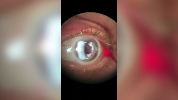 Pewien chirurg okulista pokazał, jak wygląda zabieg przekłuwania rogówki. Brian Shafer jest filadelfijskim okulistą specjalizującym się w chirurgii rogówki oraz leczeniu jaskry i zaćmy. To właśnie pacjent z jaskrą został sfilmowany w trakcie zabiegu. Brian zaaplikował mu tzw. implant durysta. Niepokojące wideo podbiło internet i zyskało wiele tysięcy wyświetleń.