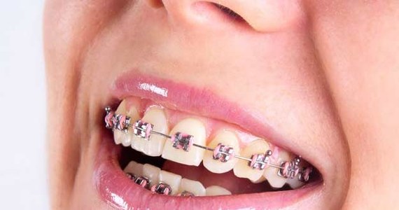 Falszywe Aparaty Ortodontyczne Kobieta W Interia Pl