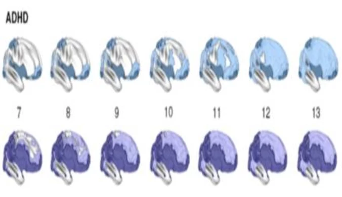 ADHD opóźnia dojrzewanie mózgu