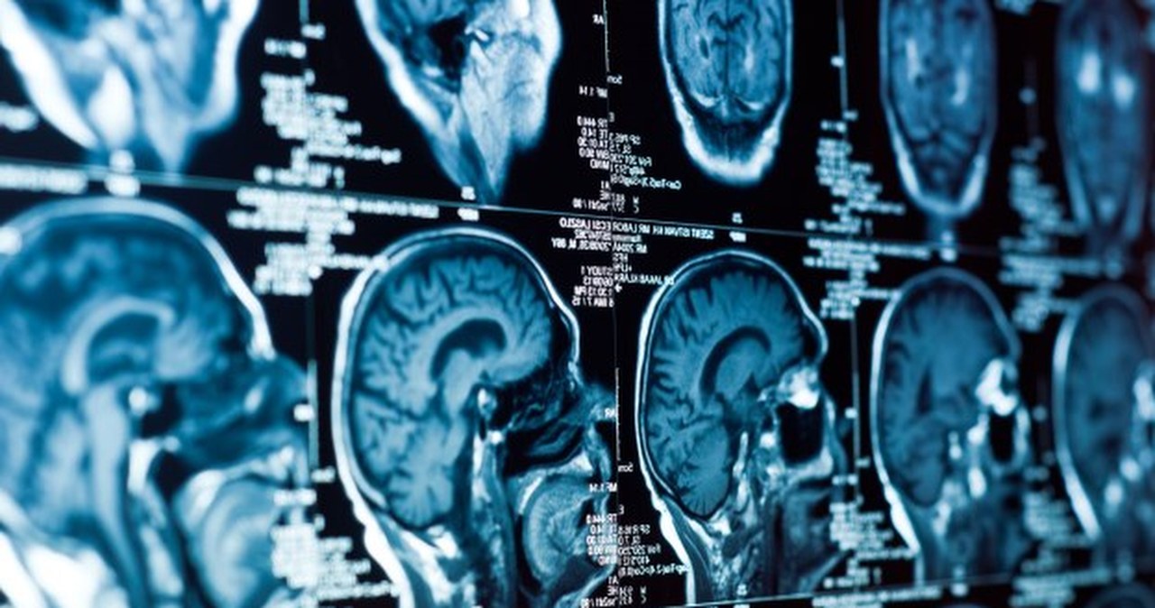 Nowa metoda wykrywa guzy mózgu w 90 minut zamiast tygodni