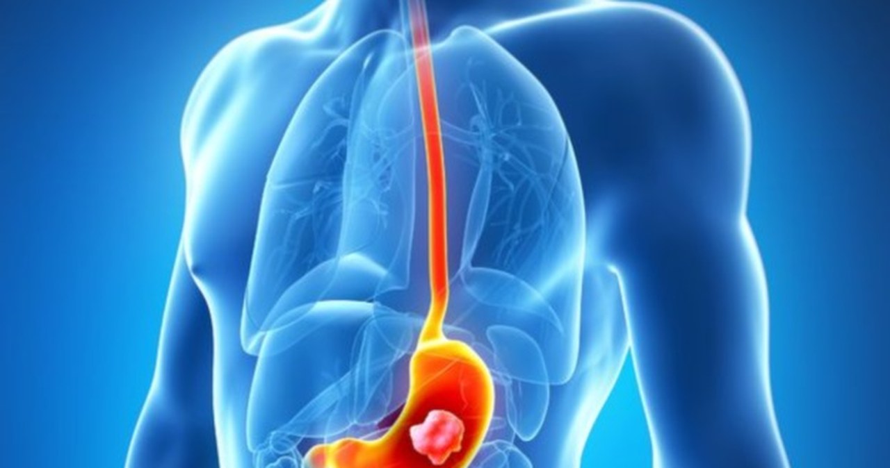 Ten rak to "cichy zabójca" naszych czasów. AI może go pokonać