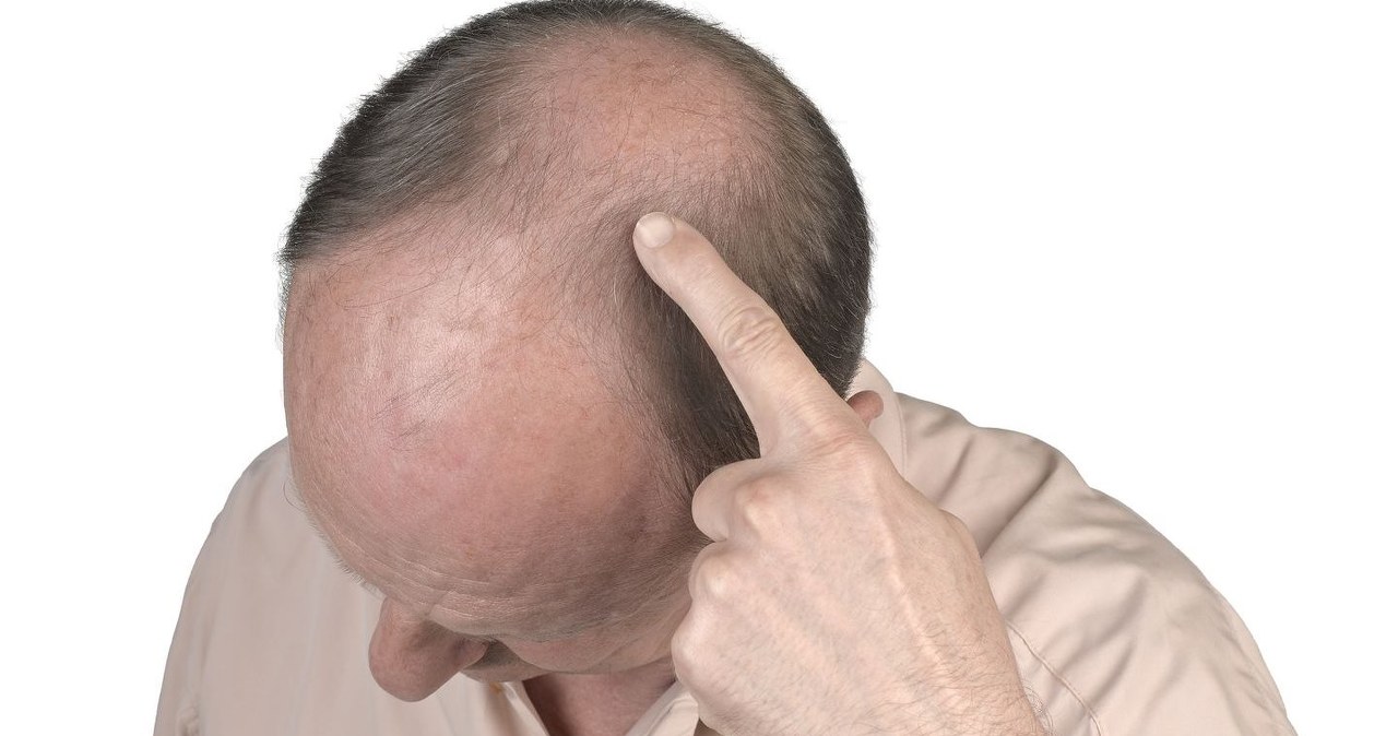 Przypadkowe odkrycie w walce z łysieniem. Naturalny cukier lepszy od leków