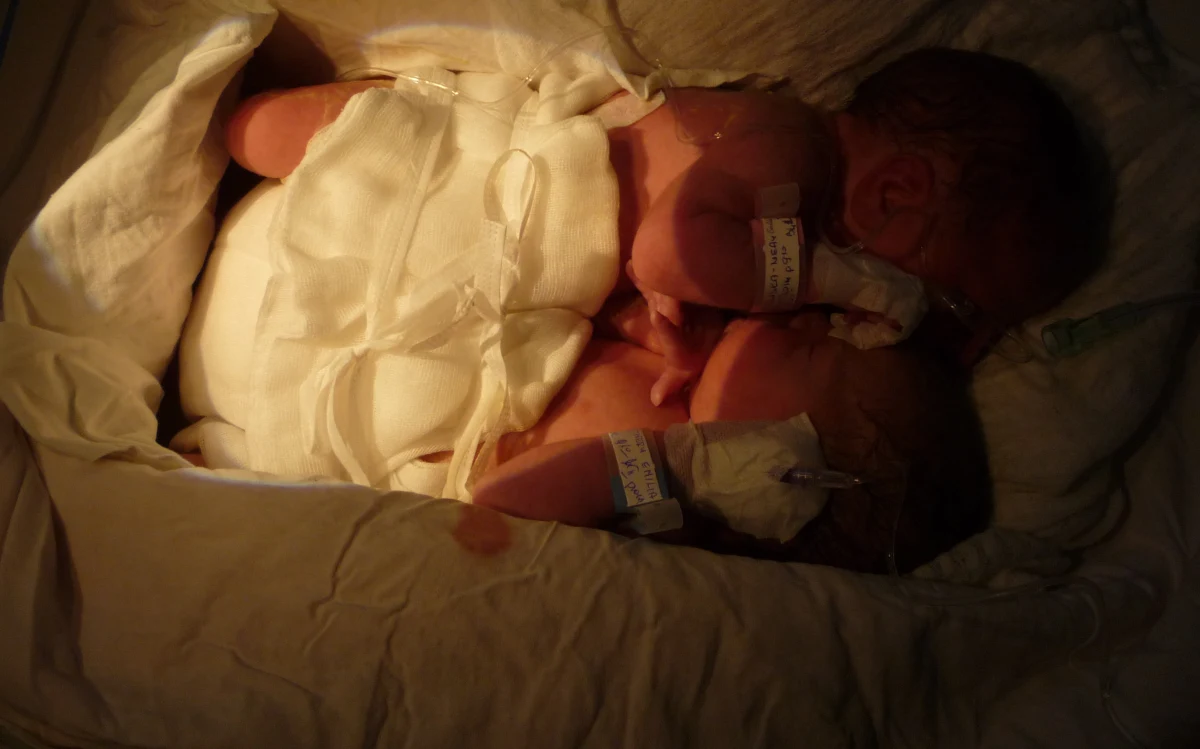 W szpitalu w Warszawie przyszły dziś na świat bliźnięta syjamskie. Chłopcy są zrośnięci brzuszkami, ich życiu nic nie zagraża. Teraz muszą przejść specjalistyczne badania, a później czeka ich operacja rozdzielenia. "Możliwe, że dzieci zostaną poddane operacji jeszcze dzisiaj" - mówi zastępca dyrektora ds. lecznictwa warszawskiego szpitala przy ul. Litewskiej Marta Kuczabska.