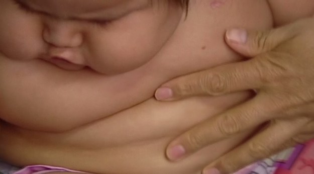 To prawdopodobnie najgrubsze niemowlę świata! 8-miesięczny Santiago z Kolumbii waży 21 kilogramów – trzy razy więcej niż wynosi średnia waga dziecka w tym wieku! Lekarze, którzy badali chłopca, są przerażeni. Zdaniem specjalistów, za otyłość chłopca nie odpowiada żadna choroba ani czynniki genetyczne. Został po prostu… przekarmiony.