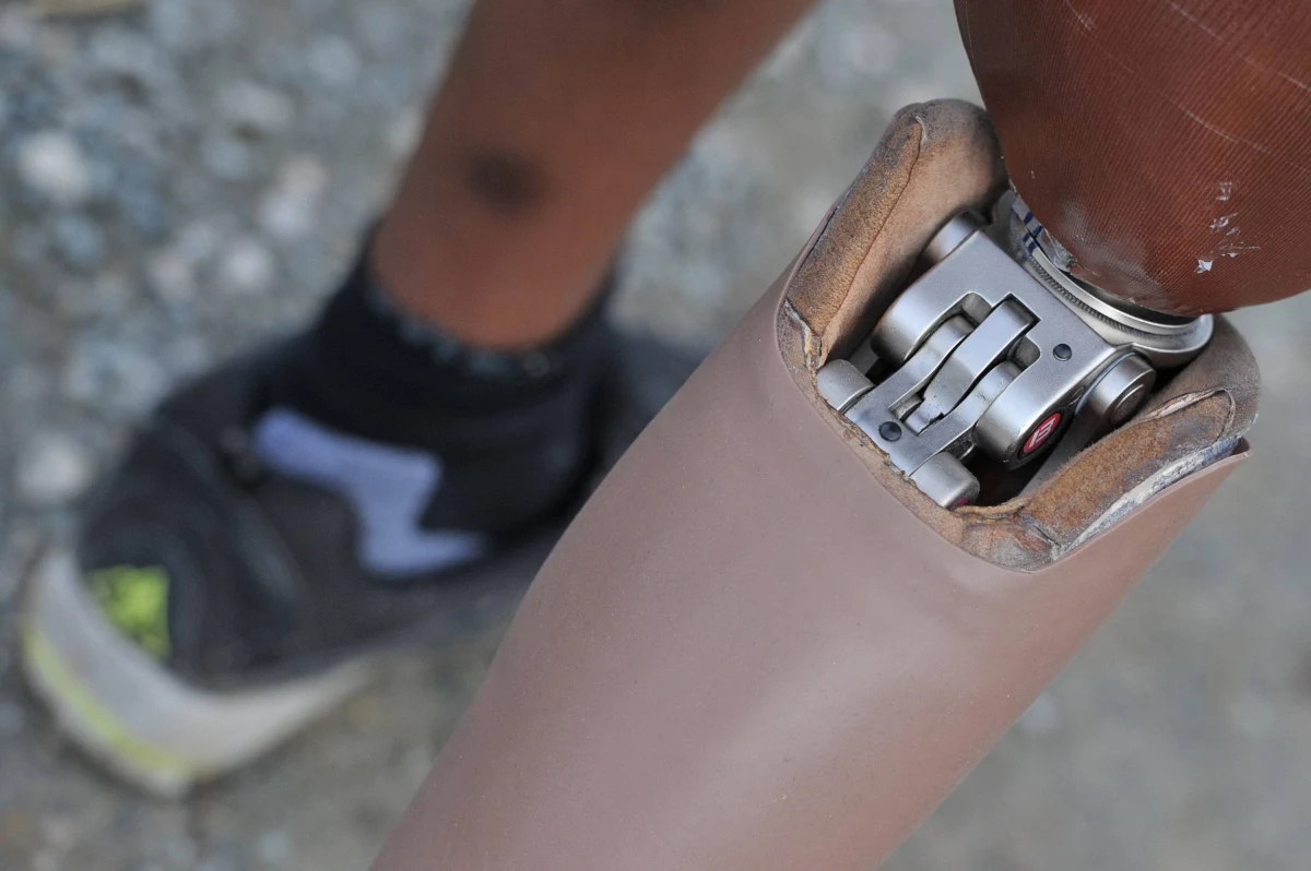 W polskich szpitalach co kilkadziesiąt minut wykonuje się zabieg amputacji nogi. Bijemy pod tym względem europejskie rekordy, bo system zachęca do nadużywania takich operacji - pisze "Rzeczpospolita".