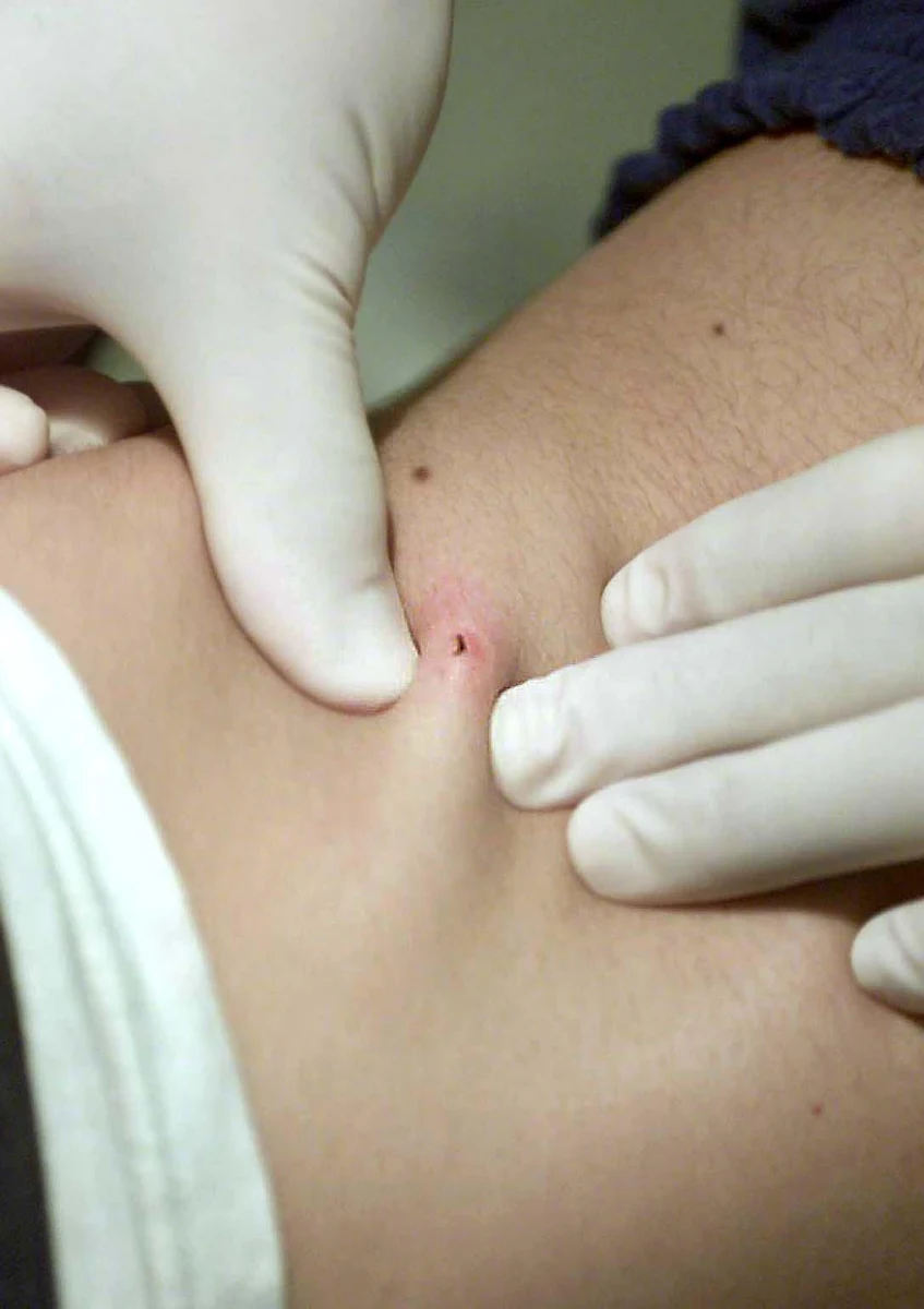 Tylko do końca czerwca na boreliozę, chorobę przenoszoną przez kleszcze, zachorowało ponad 4,7 tys. Polaków. To historyczny rekord - czytamy w "Metrze".