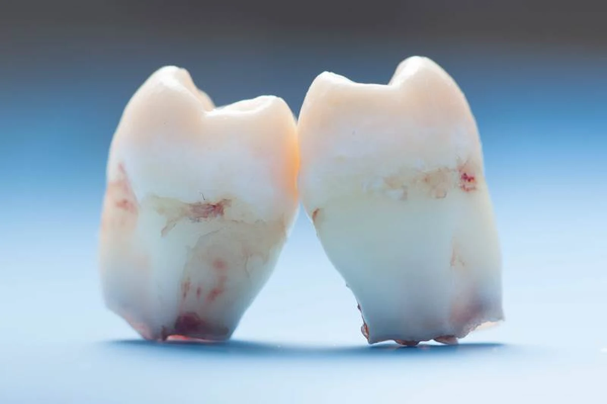 Nie 28, a 260 zębów miał w swojej szczęce 17-letni nastolatek z Indii. Dzięki 7-godzinnemu zabiegowi operacyjnemu, lekarzom udało się usunąć zbędne uzębienie młodego pacjenta. 