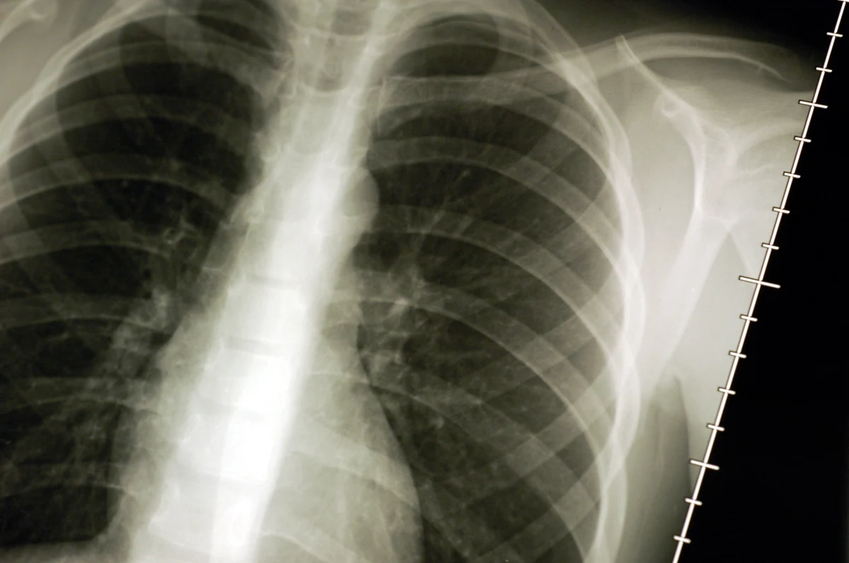 Francuscy naukowcy opracowali metodę bardzo wczesnego wykrywania raka płuc - nawet kilka lat wcześniej, zanim nowotwór będzie widoczny na zdjęciach rentgenowskich. Wszystko dzięki prostemu badaniu krwi! Pacjent dostaje ich rezultat w ciągu kilku minut.