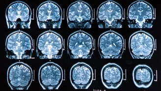 Choroba Alzheimera: Ważne odkrycie badaczy z USA