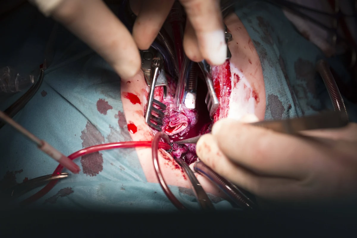 Dramatyczna pomyłka w Uniwersyteckim Szpitalu Klinicznym we Wrocławiu. Lekarz podczas usuwania guza nerki u 57-letniego mężczyzny zamiast chorego narządu usunął zdrowy. Teraz pacjenta czeka druga operacja.