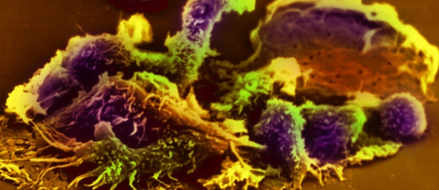Podobnie, jak bakterie czy wirusy, komórki nowotworowe mają potencjał zarażania zdrowych komórek i w związku z tym rozprzestrzeniania choroby nowotworowej - przekonują naukowcy z Uniwersytetu Delaware. Wyniki ich badań, opisane na internetowej stronie czasopisma "Journal of Cell Science" wskazują, że komórki rakowe mogą bezpośrednio oddziaływać na sąsiadujące z nimi komórki zdrowe i zmieniać je w niekorzystny dla nas sposób.