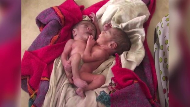 W indyjskim mieście Badaun na świat przyszły wyjątkowe bliźnięta syjamskie. Chłopcy urodzili się zrośnięci brzuchami, co oznacza, że nie posiadają odrębnych narządów wewnętrznych. Ich zdrowiu nie zagraża niebezpieczeństwo, jednakże lekarze nie dają im dużych szans na przeżycie.


Bliźniaki urodziły się w wyniku cesarskiego cięcia. Ginekolog, który odbierał poród, mówił, że to był pierwszy taki przypadek w jego karierze. O tym, że bracia urodzą się złączeni, dowiedział się w ostatniej możliwej chwili. Ich rodziców nie było stać na wykonanie drogiego badania USG. Rodzeństwo oraz ich mama obecnie pozostają pod opieką miejscowych lekarzy. Wkrótce zostaną skierowani do większego szpitala, gdzie bliźniakami zajmą się specjaliści.
