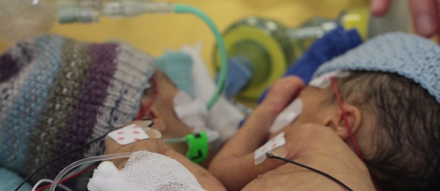 Szwajcarscy chirurdzy rozdzielili prawdopodobnie najmłodsze na świecie, zaledwie ośmiodniowe bliźniaczki syjamskie, które przeżyły, choć szanse na powodzenie zabiegu były minimalne - informuje "BBC News".
