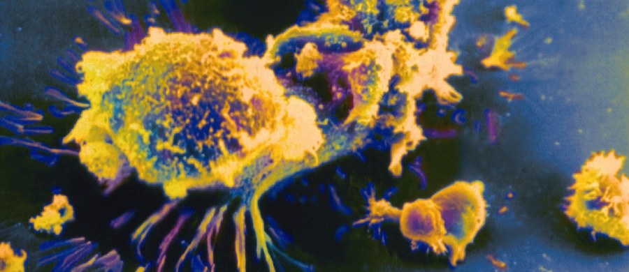 Wszystko wskazuje na to, że została wynaleziona nowa, rewolucyjna metoda, która może być wykorzystywana w leczeniu niektórych typów nowotworów. Ratunkiem dla chorych m.in. na białaczkę może być genetycznie modyfikowana krew. 