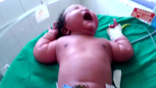 19-letnia Nadini z Indii urodziła dziecko, które już przeszło do historii. Jako najgrubsza dziewczynka-niemowlę na świecie. Mała waży 6,8 kg! Przyszła na świat przez cesarskie cięcie w szpitalu rządowym w Hassan, w południowym stanie Karnataka. 


Przeciętna waga niemowlaka to 3,4 kg. Nic więc dziwnego, że dziecko wzbudziło sensację tym bardziej, że matka w ciąży nie chorowała na cukrzycę, nie miała też stwierdzonych problemów z tarczycą – a to właśnie te choroby przyczyniają się do nadwagi niemowląt. Trzeba jednak dodać, że Nadini też do szczupłych nie należy. Waży 94 kilogramy.


Zarówno matka, jak i dziecko czują się dobrze. Trzymamy kciuki!