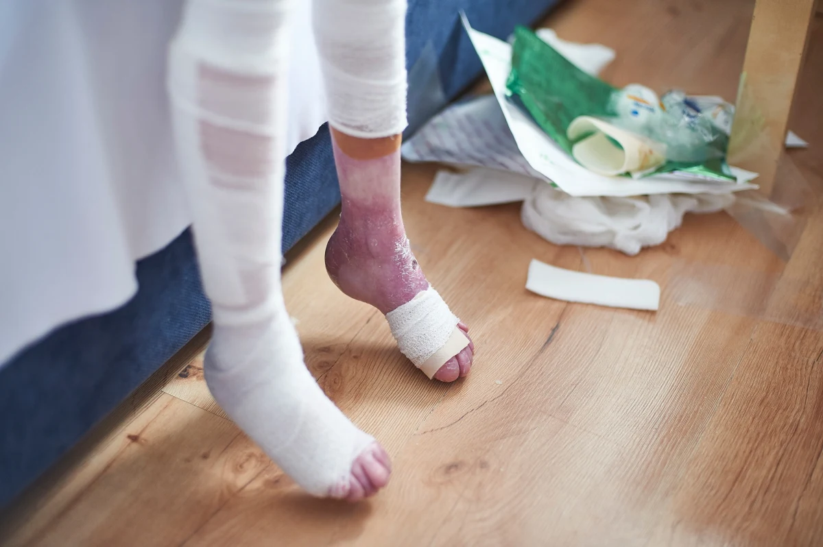 Dwa tysiące bezpłatnych opatrunków trafi do chorych na EB, czyli pęcherzowe oddzielanie się naskórka. To efekt dzisiejszego spotkania w Ministerstwie Zdrowia. Od stycznia - wraz z nową listą leków refundowanych - część niezbędnych dla chorych opatrunków podrożała nawet o ponad 700 złotych. Oznacza to wydatek rzędu ponad tysiąca złotych. Bezpłatne opatrunki czekają w magazynach, jeszcze w tym tygodniu mogą trafić do pacjentów. U chorych na EB nie można stosować zwykłych opatrunków, bo przy zmianie spowodują one odrywanie bardzo delikatnego naskórka i powstawanie kolejnych ran. Konieczne jest więc stosowanie specjalistycznych opatrunków, co nie tylko zmniejsza ryzyko powikłań, ale także ogranicza ból. 