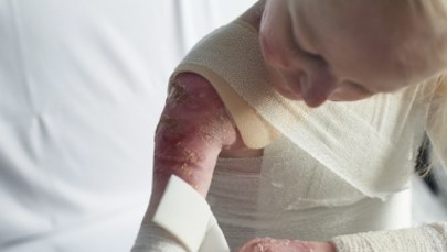 Chorzy na EB dostaną bezpłatne opatrunki. Bandaże podrożały o ponad 700 proc.