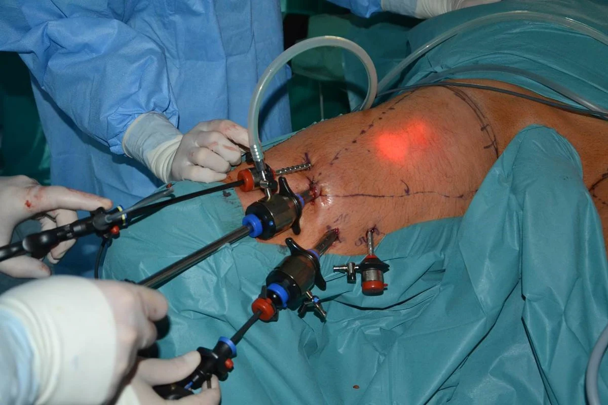 Po raz pierwszy w Polsce w czasie nowatorskiej operacji usunięto węzły chłonne w nowotworze męskich narządów płciowych nie przez pachwinę, ale nacięcie na nodze. Do tej pory takie zabiegi robiono tylko w Stanach Zjednoczonych. W Krakowie skomplikowaną operację przeprowadził zespół prof. Piotra Chłosty, szefa Kliniki Urologii i Urologii Onkologicznej. Jest szansa, że pacjent jeszcze w tym tygodniu wyjdzie do domu. Wykonana metodą laparoskopową operacja zmniejsza ryzyko powikłań i znacznie poprawia komfort życia pacjenta. 