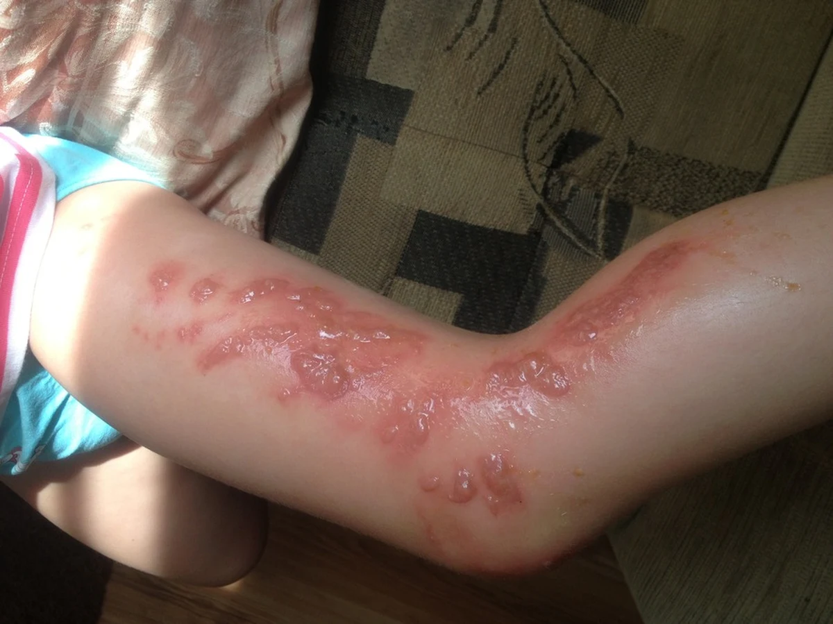 Barszcz Sosnowskiego jest niebezpieczny w kontakcie ze skórą. "Po oparzeniu dochodzi do reakcji alergicznej. Sytuacja pogarsza się w kontakcie z promieniami słonecznymi" – mówi w rozmowie z RMF FM dr Justyna Glik z Centrum Leczenia Oparzeń w Siemianowicach Śląskich. Barszcz Sosnowskiego rośnie m.in. na łąkach, nad wodą i na niestrzeżonych kąpieliskach. Trudno unikać tych miejsc, zwłaszcza w czasie wakacji. Poniżej zbiór informacji, które o barszczu Sosnowskiego wiedzieć należy. 