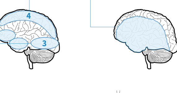 Co Się Dzieje Z Mózgiem Podczas Choroby Alzheimera Infografika Twojezdrowiepl 1292