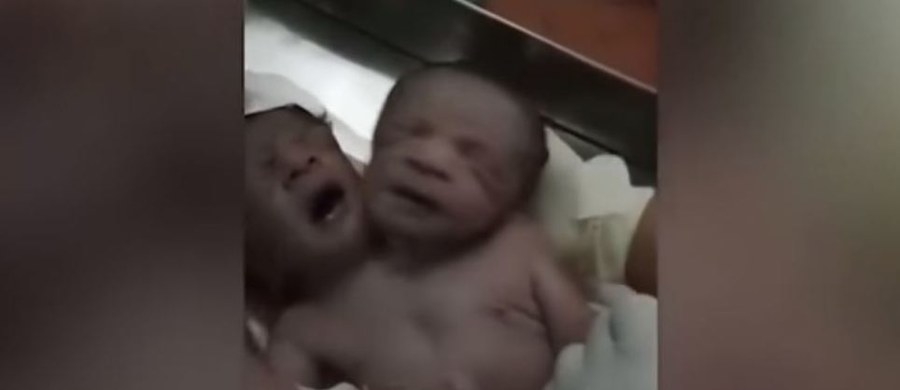 ​Taka sytuacja trafia się raz na milion. W Indiach urodziły się bliźniaki syjamskie, których łączyło jedno ciało. Wyglądały więc jak jedno dziecko, ale z dwiema głowami. Obaj chłopcy zmarli niestety po dobie.