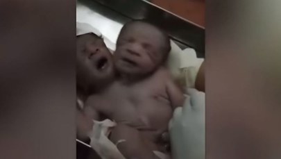 Dziecko z dwiema głowami urodziło się w Indiach