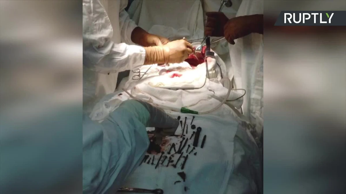 Niemałe zaskoczenie czekało lekarzy w szpitalu w Ułan-Ude na Syberii, gdy z bólem brzucha trafiła do nich 74-letnia kobieta. Okazało się, że w jej żołądku znajdują się metalowe przedmioty. Konieczna była operacja, w trakcie której z żołądka pacjentki wydobyto 152 śruby, gwoździe i wkręty oraz srebrny łańcuszek - wszystko ważyło łącznie ponad kilogram. Pacjentka nie potrafiła wyjaśnić lekarzom, dlaczego połykała metalowe przedmioty.