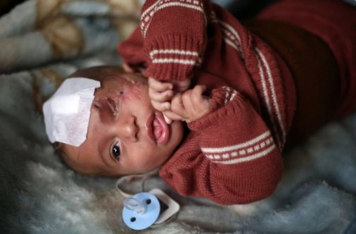 Karim Abdallah stracił oko, gdy miał niecałe dwa miesiące. Niemowlę wraz matką znaleźli się pod ostrzałem wojsk rządu syryjskiego we Wschodniej Ghucie. Dziś w połowie oślepione syryjskie dziecko stało się symbolem umęczonej enklawy.