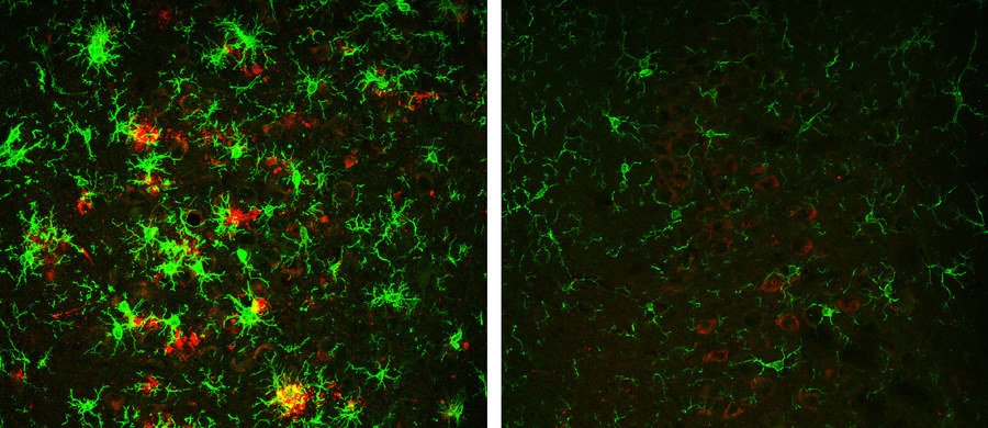 Nowe nadzieje w poszukiwaniach terapii choroby Alzheimera. Badacze z Cleveland Clinic Lerner Research Institute odkryli metodę, która po raz pierwszy pozwala w mózgu myszy cierpiącej na tę chorobę odwrócić proces tworzenia się charakterystycznych złogów białkowych. Powstawanie owych blaszek beta-amyloidu, które zaburzają precę neuronów uważa się za mozliwą przyczynę towarzyszących chorobie Alzheimera zaburzeń. Jeśli da się ten proces odwrócić, szanse na skuteczną terapię tej nieuleczalnej wciąż choroby znacznie wzrosną. Pisze o tym w najnowszym numerze czasopismo "Journal of Experimental Medicine".