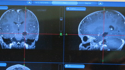 Chirurdzy otworzyli czaszkę niewłaściwemu pacjentowi. Zorientowali się po kilku godzinach