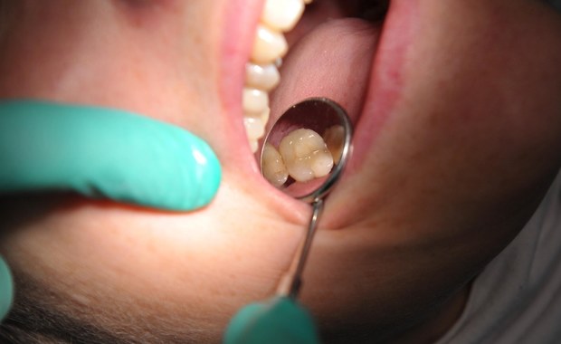 ​Ciemnych amalgamatowych plomb dentyści nie będą mogli zakładać już u dzieci, kobiet w ciąży i karmiących matek. Zakaz wszedł w życie 1 lipca. Wprowadziło go rozporządzenie Parlamentu Europejskiego - poinformowała Komisja Stomatologiczna NRL.