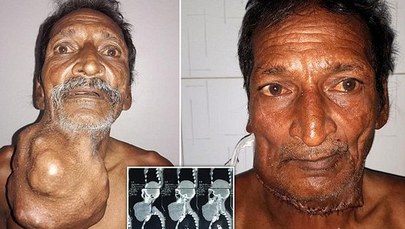 Indyjski rolnik po usunięciu 1,4-kilogramowego guza. Rósł przez 20 lat!
