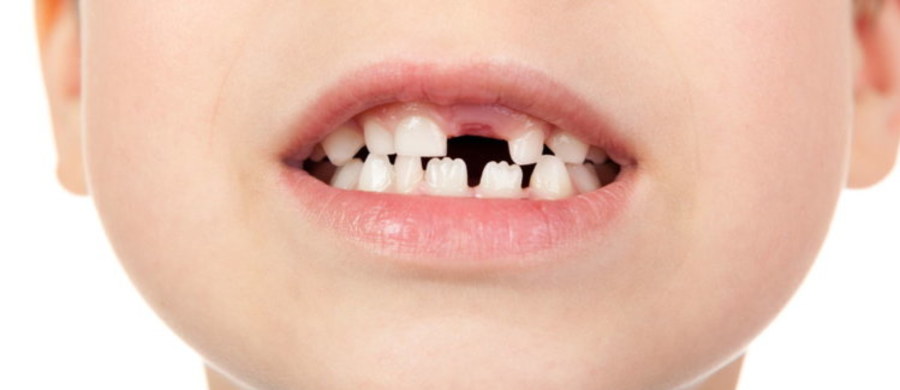 Wady wymowy, zahamowanie wzrostu kości oraz niepotrzebny ból – to tylko niektóre z nieprzyjemnych następstw braku odpowiedniej opieki nad mleczakami malucha. Część rodziców błędnie sądzi, że nie warto przejmować się zębami mlecznymi, skoro i tak wypadną. Ortodonta Kamila Wasiluk, przestrzega przed takim podejściem. Przedwczesna utrata zębów mlecznych, czyli na 3-4 lata przed terminem ich fizjologicznego wypadnięcia, prowadzi do przykrych konsekwencji w dorosłym życiu – stłoczeń zębowych, czy różnego rodzaju wad zgryzu. 