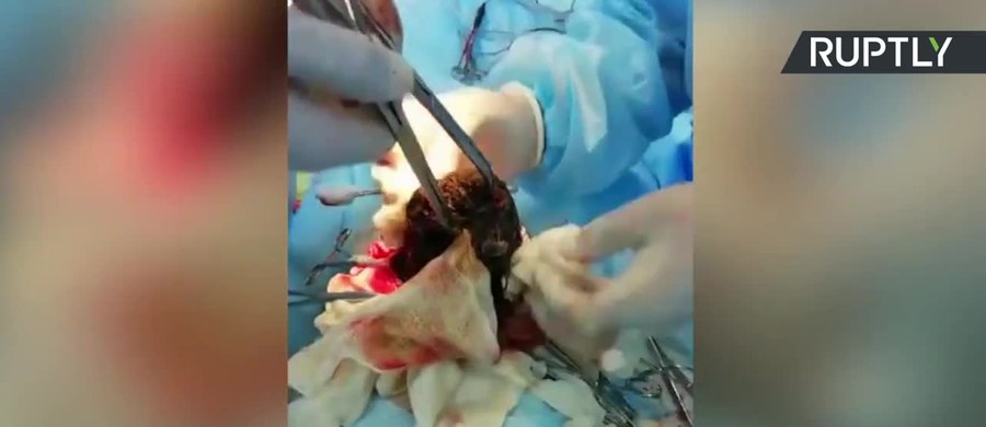 Chirurdzy usunęli z żołądka 12-latki kulę włosów ważącą 3,5 kilograma. Operację przeprowadzono w szpitalu w obwodzie mangystauskim na zachodzie Kazachstanu. 