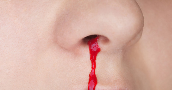 Dlaczego Cieknie Krew Z Nosa Kobieta W Interiapl
