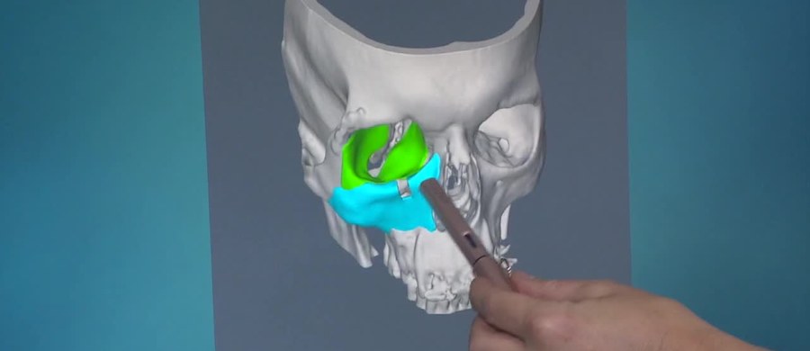 ​Lekarze ze Szpitala Klinicznego im. A. Mielęckiego w Katowicach zrekonstruowali twarz mężczyzny, zniekształconą w wyniku wypadku, za pomocą specjalnie przygotowanego, złożonego implantu kości twarzy. 46-letni pacjent wraca do normalnego życia. "To naprawdę wielkie szczęście, że trafiłem na panią profesor i taki wspaniały zespół" – ocenił pacjent.