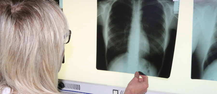 Pilotażowe w Polsce i w Unii Europejskiej badania przesiewowe wczesnego wykrywania raku płuca rozpoczną się w pierwszym kwartale 2019 roku – poinformował prof. Mariusz Adamek ze Śląskiego Uniwersytetu Medycznego w Katowicach.