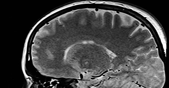 Ważne odkrycie francuskich i amerykańskich naukowców w walce z chorobą Alzheimera. Twierdzą oni, że znaleźli sposób na spowolnienie rozwoju tej choroby poprzez dążenie do lepszego ukrwienia mózgu.