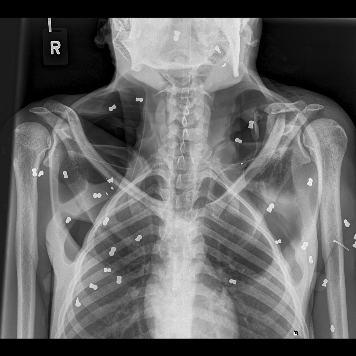 Ciężko ranną samicę orangutana znaleziono w lasach indonezyjskiej Sumatry. W jej ciele utkwiły 74 pociski wystrzelone z broni pneumatycznej. 