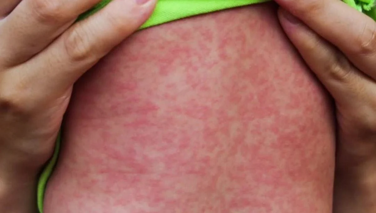 ​Stany Zjednoczone odnotowały w tym roku najwyższy od 2000 roku wzrost zachorowań na odrę. Amerykańskie Centrum Kontroli Chorób i Prewencji (CDC) podało, że w 2019 roku odnotowano 695 przypadków zachorowań. Najwięcej - w Nowym Jorku i w Waszyngtonie.