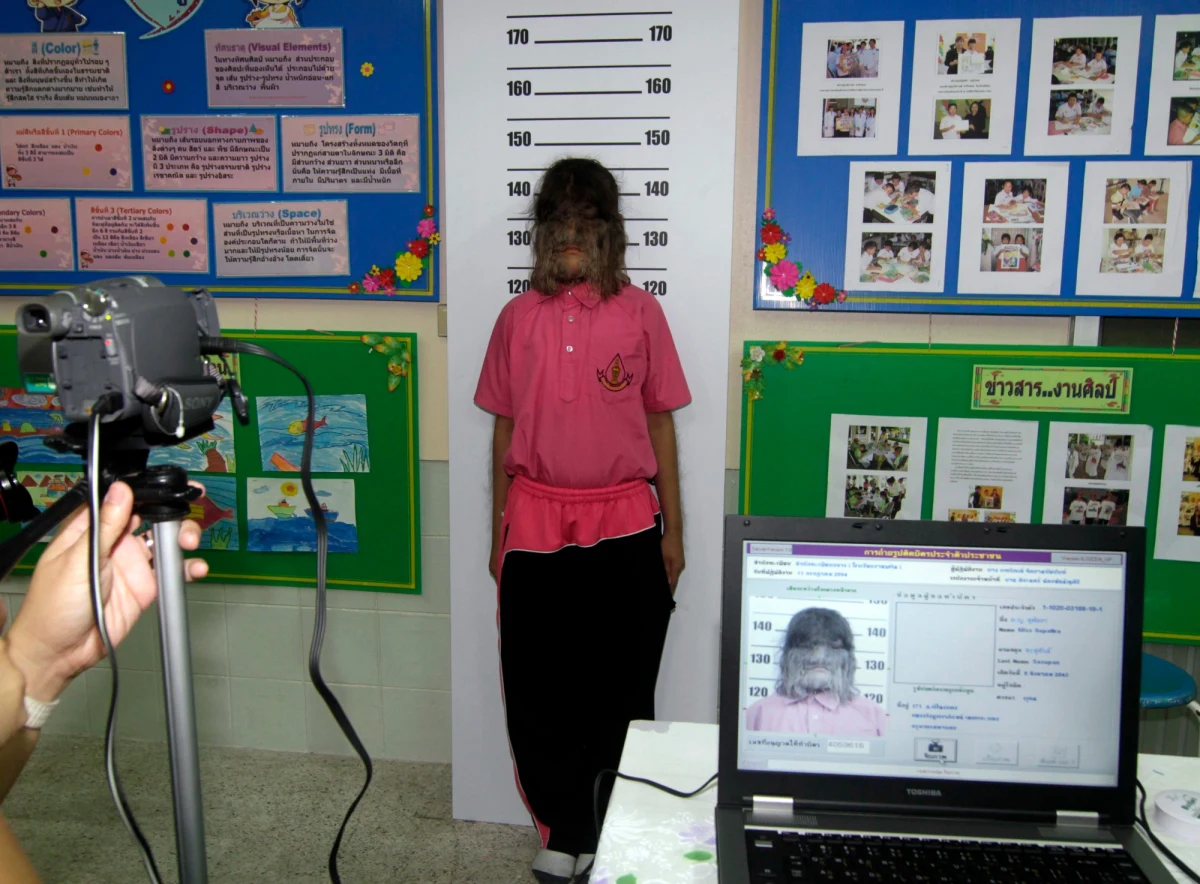 Ministerstwo zdrowia Hiszpanii wykryło pomyłkę u producenta leku dla dzieci, która u siedemnaściorga z nich doprowadziła do hipertrichozy. Choroba, zwana też “zespołem wilkołaka”, powoduje nadmierne owłosienie w dowolnej okolicy ciała.