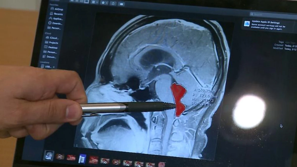 Po latach niewyobrażalnego bólu głowy pewien mieszkaniec Teksasu w końcu doczekał się diagnozy. W jego mózgu zalągł się tasiemiec. Pasożyta usunięto chirurgicznie. 