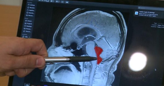 Po latach niewyobrażalnego bólu głowy pewien mieszkaniec Teksasu w końcu doczekał się diagnozy. W jego mózgu zalągł się tasiemiec. Pasożyta usunięto chirurgicznie. 