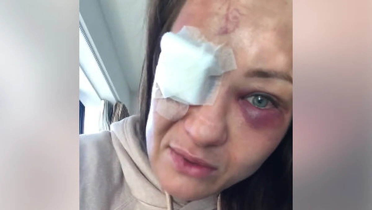 Wyjątkowo niefortunnie zakończył się dla Karoliny Kowalkiewicz występ na gali UFC w Auckland. Polka nie tylko przegrała walkę z Chinką Xiaonan Yan, ale nabawiła się również poważnego urazu oka. "Przez całą walkę praktycznie nic nie widziałam, widziałam podwójnie, wszystko było jak we mgle" - relacjonuje zawodniczka w nagraniu wideo opublikowanym w mediach społecznościowych. Konieczna będzie operacja.