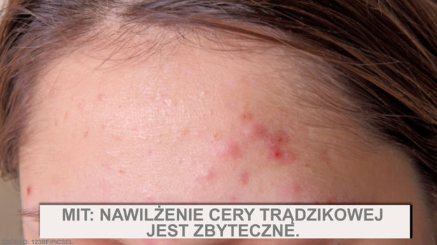 Trądzik dotyka ponad 80 procent ludzi. Czyli prawie każdy miał, ma lub będzie mieć jakąś jego postać. To najpowszechniejsza choroba dermatologiczna. Występuje u coraz młodszych i coraz starszych.