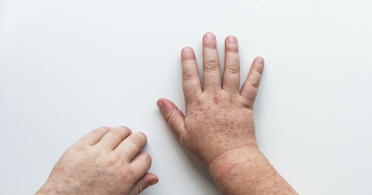 Genom sprzed wieków ujawnia tajemnicę szkarlatyny. Zaskakujące odkrycie